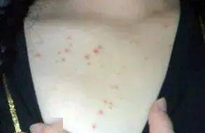 硬下疳高清图 早期:硬下疳高清图,早期识别与预防,你必须知道的梅毒知识 硬下疳高清图 早期:硬下疳高清图,早期识别与预防,你必须知道的梅毒知识