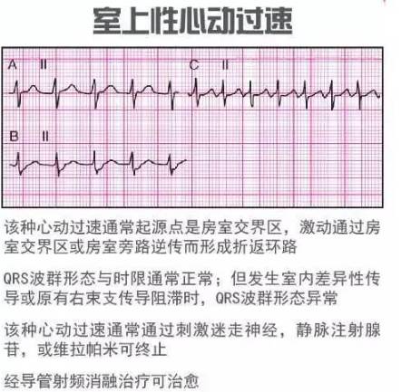 心电图怎么看图解:心电图怎么看?图解入门指南