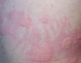 儿童身上突然过敏图片:儿童身上突然过敏,症状、原因与应对措施