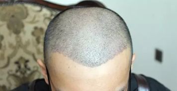 种植头发的价格一般多少钱：植发手术价格，你需要知道的一切