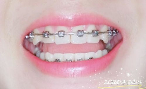 牙套什么年龄戴合适：牙套什么年龄戴合适？