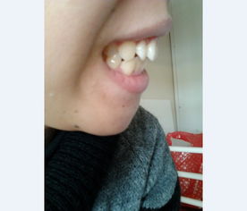 牙套什么年龄戴合适：牙套什么年龄戴合适？