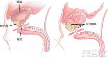 前列腺治疗方法哪个最有效：前列腺治疗，哪种方法最有效？