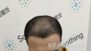 植发是拆东墙补西墙吗：植发，是拆东墙补西墙的权宜之计，还是重拾自信的有效途径？