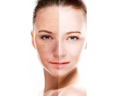 脸上的斑斑点点怎么去除：告别斑斑点点，重拾无瑕肌肤，科学方法助你有效去除脸上的色斑