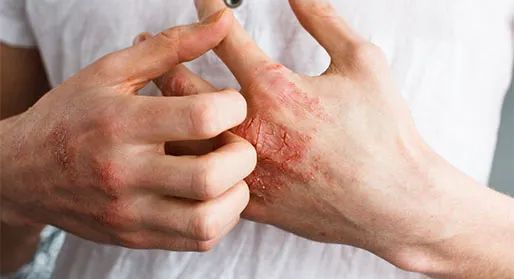 脂溢性皮炎最怕的克星：痒到抓狂？脂溢性皮炎的终极克星在这里！