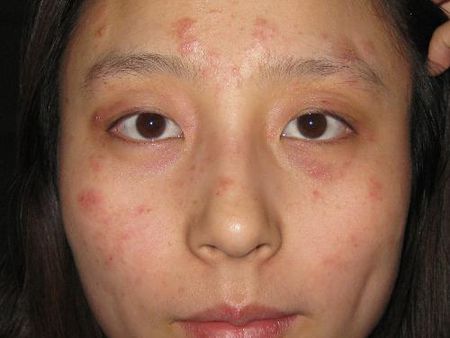 脂溢性皮炎最怕的克星:痒到抓狂?脂溢性皮炎的终极克星在这里!