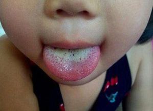 舌苔厚白怎么快速去除：快速去除舌苔厚白的方法与健康提示