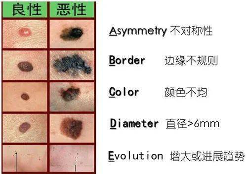 脸上哪些痣不能取：脸上哪些痣不能取？这5种危险信号要警惕
