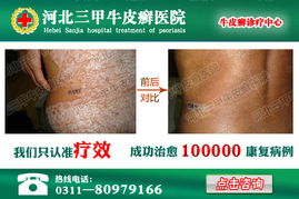 治癣的最好土方：祖传秘方！治癣的最好土方，一学就会，一用就灵！