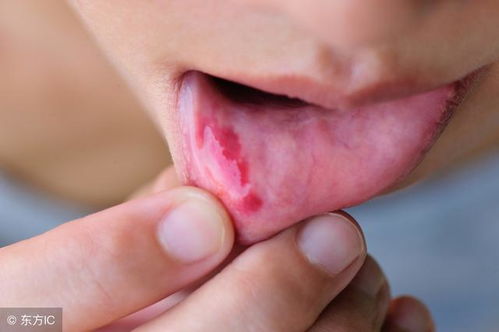 口腔癌早期症状：口腔癌早期症状，这些信号千万别忽视！