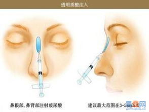 隆鼻子要多少钱：隆鼻子要多少钱？全面解析价格因素与选择建议