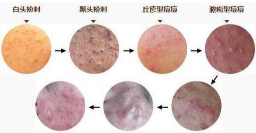 毛囊炎和痤疮的区别图：毛囊炎和痤疮，相似但不同的皮肤问题，如何区分？
