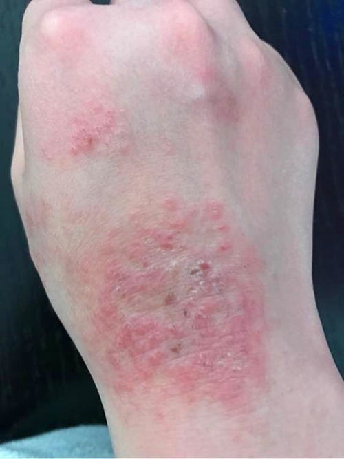 湿疹反反复复如何彻底根除：湿疹反反复复怎么办？专家支招，系统管理，迈向根除之路