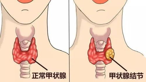 甲状腺医生在线咨询：甲状腺问题在线咨询靠谱吗？这些注意事项要知道！