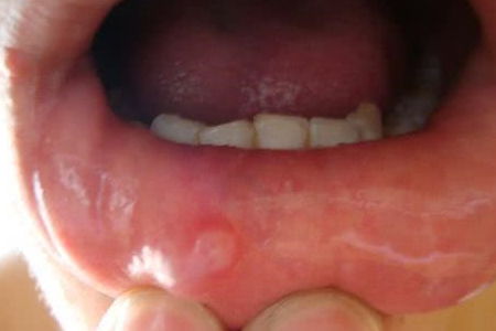 嘴巴上火起泡溃烂怎么快速消除：嘴巴上火起泡溃烂怎么快速消除？告别口腔溃疡的实用指南