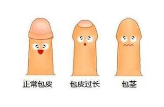 30岁有必要割包茎手术:30岁了,割包茎有必要吗?关于成年后包茎手术的理性思考 30岁有必要割包茎手术:30岁了,割包茎有必要吗?关于成年后包茎手术的理性思考