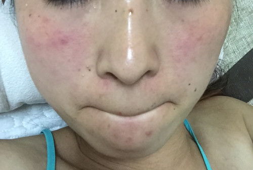 眼周过敏性皮炎皱巴巴：告别皱巴巴！眼周过敏性皮炎的救星在这里