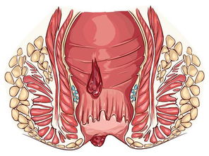 怎样判断自己是不是痔疮:这些症状,你中招了吗?怎样初步判断自己是不是得了痔疮 怎样判断自己是不是痔疮:这些症状,你中招了吗?怎样初步判断自己是不是得了痔疮