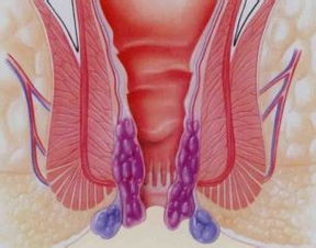 怎样判断自己是不是痔疮：这些症状，你中招了吗？怎样初步判断自己是不是得了痔疮