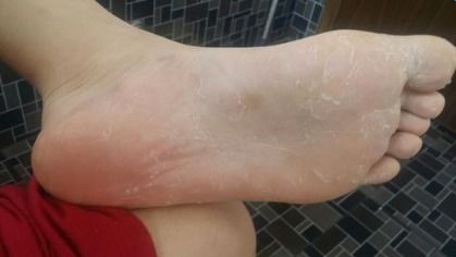 脚部湿疹与脚气区别图：脚部湿疹与脚气区别图，一文看懂！