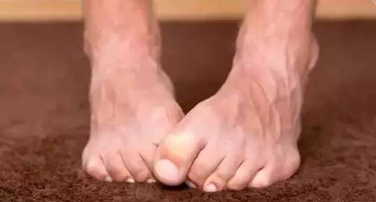 脚部湿疹与脚气区别图：脚部湿疹与脚气区别图，一文看懂！