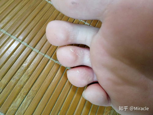 脚部湿疹与脚气区别图：脚部湿疹与脚气区别图，一文看懂！