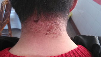 神经性皮炎怎么治疗最有效：神经性皮炎怎么治疗最有效？综合方案与科学管理