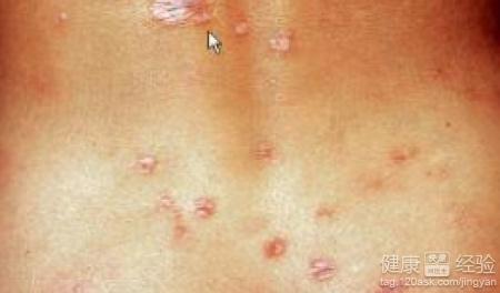 硬下疳一分钟自测：硬下疳一分钟自测，掌握早期梅毒识别关键