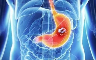 胰腺癌晚期能活多久：胰腺癌晚期生存期，影响因素与生活质量提升策略