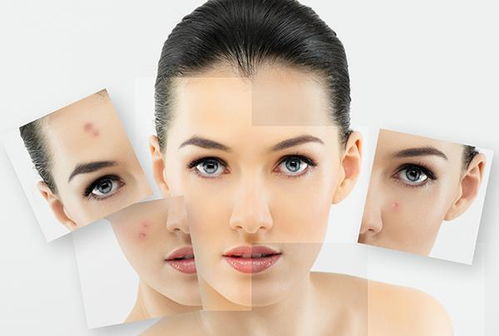 青春痘怎样才能消失:告别青春痘,科学方法助你重获光滑肌肤 青春痘怎样才能消失:告别青春痘,科学方法助你重获光滑肌肤