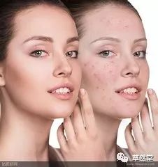 青春痘怎样才能消失:告别青春痘,科学方法助你重获光滑肌肤 青春痘怎样才能消失:告别青春痘,科学方法助你重获光滑肌肤