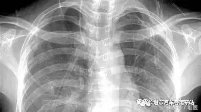 我想看胸片曝光：我想看胸片曝光，如何获取、理解与解读您的胸部X光检查报告