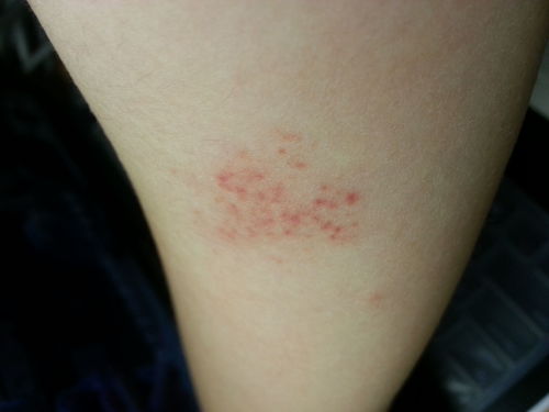 红疮狼斑会传染吗：红疮狼斑会传染吗？解析常见皮肤症状的传染风险