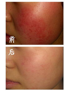 红血丝皮肤怎么修复:红血丝皮肤怎么修复?一份温和有效的护肤指南 红血丝皮肤怎么修复:红血丝皮肤怎么修复?一份温和有效的护肤指南