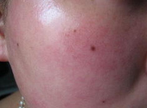 红血丝皮肤怎么修复:红血丝皮肤怎么修复?一份温和有效的护肤指南 红血丝皮肤怎么修复:红血丝皮肤怎么修复?一份温和有效的护肤指南