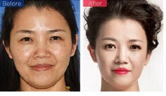 调节内分泌祛斑的方法：调节内分泌祛斑的方法，从根源改善肌肤状态