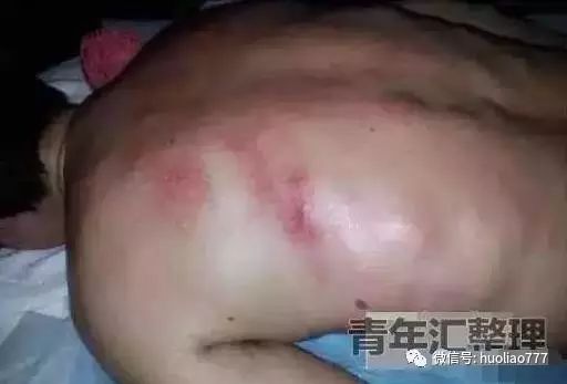 阴囊湿疹用什么药根治：阴囊湿疹困扰？这些药物和方法帮你彻底摆脱困扰