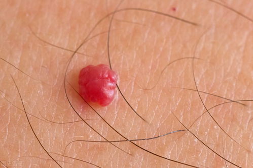 滴虫是男人在外面乱来引起的吗：滴虫感染，男性乱来是唯一原因吗？