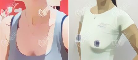 假体隆胸取出干瘪图片：揭秘假体隆胸取出干瘪图片，真相与注意事项