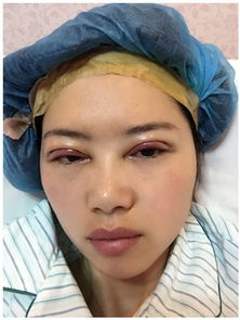 割双眼皮有什么后遗症吗：割双眼皮真的安全吗？全面解析双眼皮手术可能存在的后遗症