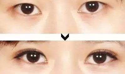 割双眼皮有什么后遗症吗：割双眼皮真的安全吗？全面解析双眼皮手术可能存在的后遗症