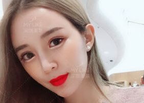 割双眼皮有什么后遗症吗：割双眼皮真的安全吗？全面解析双眼皮手术可能存在的后遗症