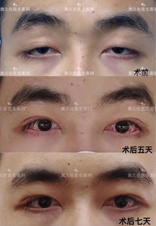 重度上睑下垂手术成功率：重度上睑下垂手术成功率高吗？全面解析与注意事项