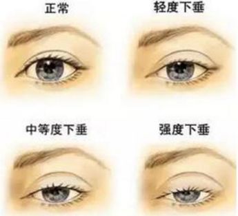 重度上睑下垂手术成功率:重度上睑下垂手术成功率高吗?全面解析与注意事项