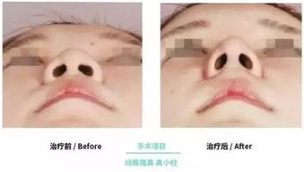 硅胶隆鼻和膨体哪个好：硅胶隆鼻 vs.膨体隆鼻，哪种隆鼻材料更适合你？