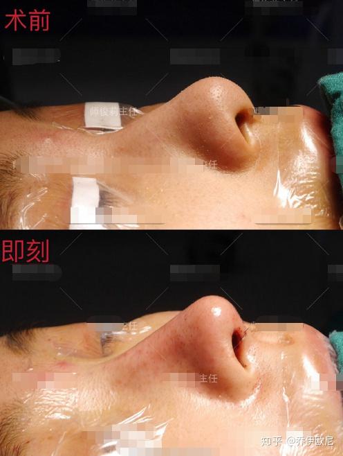 硅胶隆鼻和膨体哪个好:硅胶隆鼻 vs.膨体隆鼻,哪种隆鼻材料更适合你?