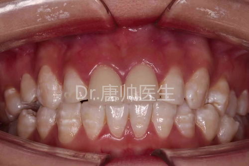 现在种一颗牙要多少钱:现在种一颗牙要多少钱?详解种植牙费用及影响因素