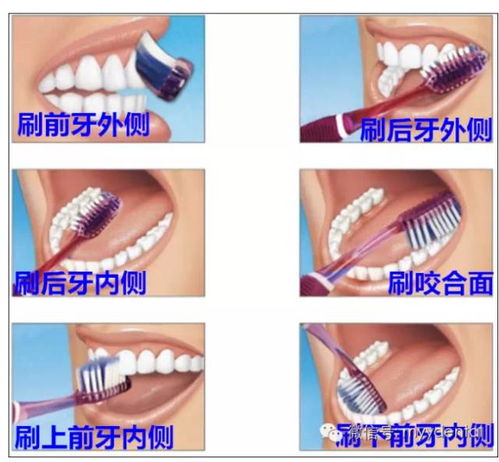 现在种一颗牙要多少钱：现在种一颗牙要多少钱？详解种植牙费用及影响因素