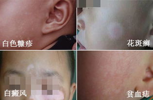 小孩五岁了白斑怎么办：五岁小孩脸上出现白斑怎么办？家长必读指南